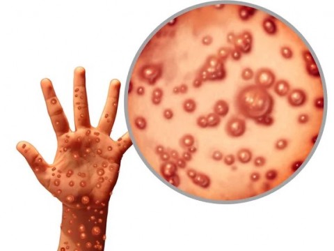 VIRUS CACAR MONYET : ANCAMAN MONKEYPOX KIAN SERIUS